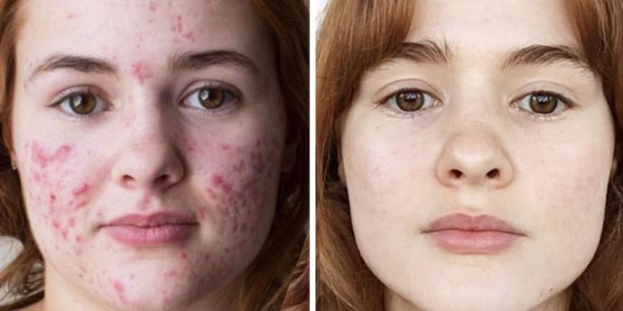 Roaccutane kullananlar var mı?