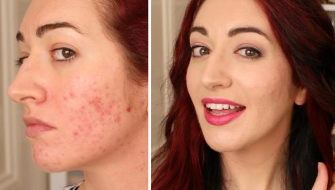 Roaccutane kullananlar var mı?