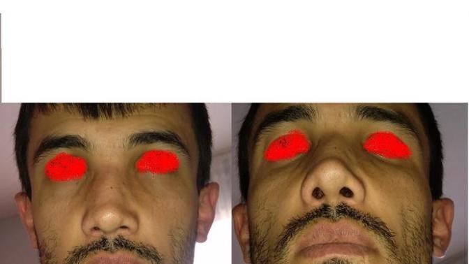 Ankara  burun estetiği ve kbb?
