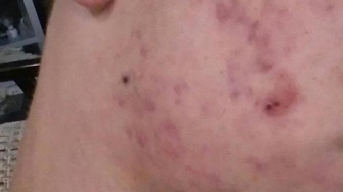 Roaccutane 5. Ay sivilcelerim geçmedi?