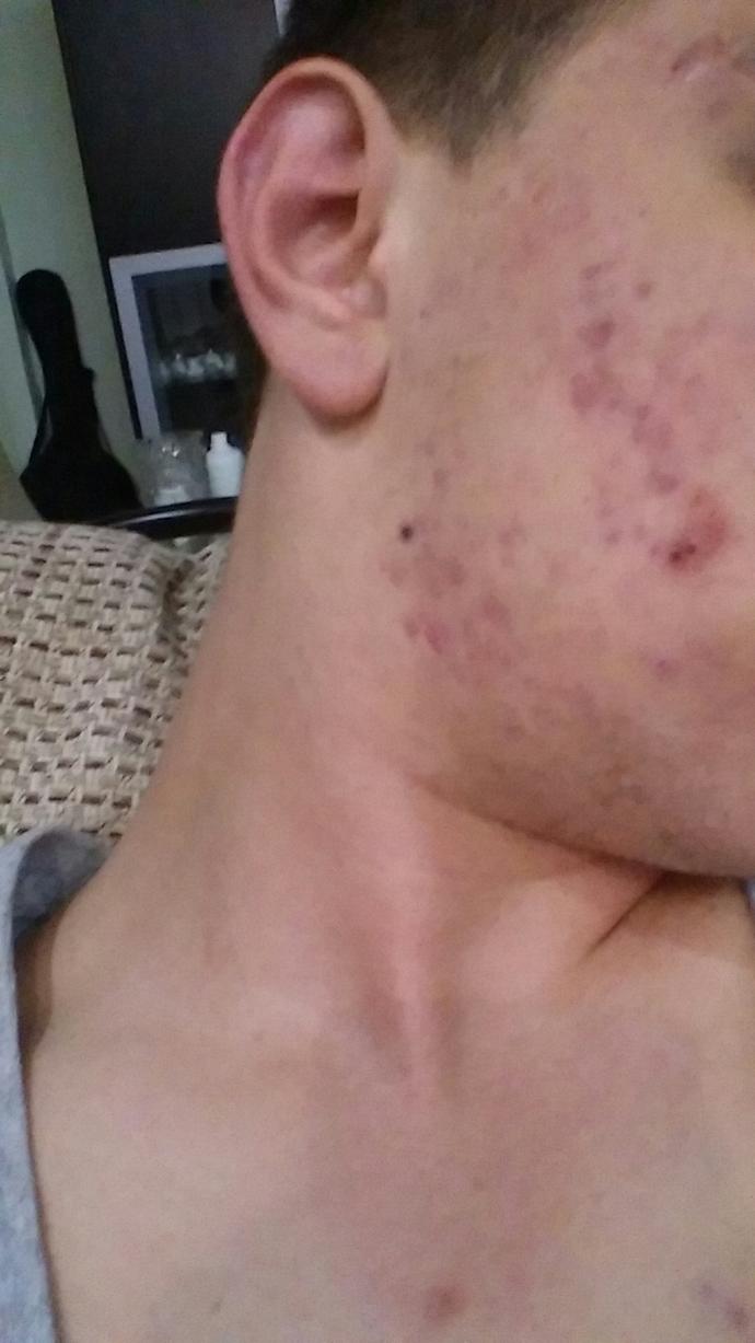 Roaccutane 5 aydayım sivilceler geçmedi normal mi ?