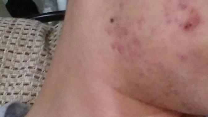 Roaccutane 5 aydayım sivilceler geçmedi normal mi?