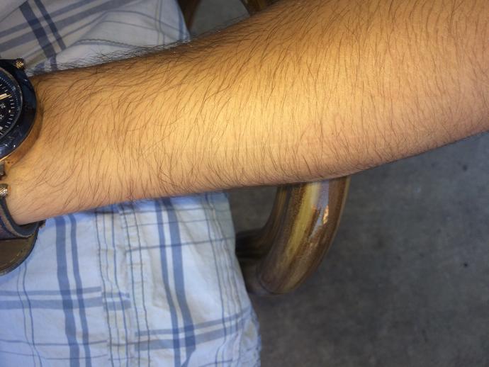 Kolumdaki çizik sizce sağlık muayenesinde sorun olur mu? Resimliiiii?