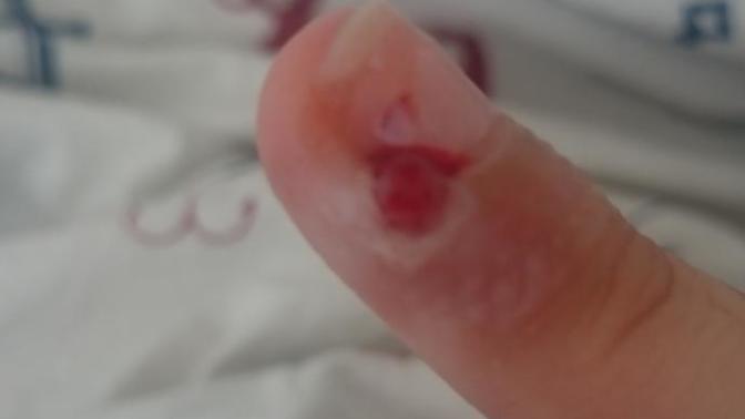 Parmağım şişti geçer diye önemsemedim sanki kalbim orda atıyomuş gibi çok canım yanıyo dolama sanırım yara bandı sardım kanadı ve sarı sıvı aktı?