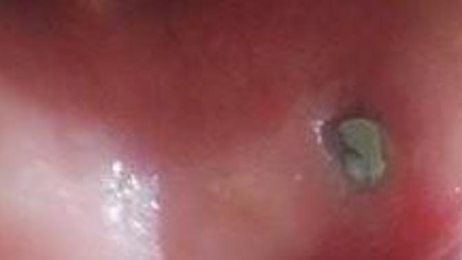Dudak Piercing'i yaptırdım ama bir garip oldu bakar mısınız?