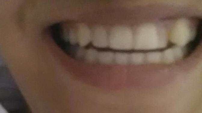 Tek dişin yamuk olması sorun olur mu? FOTOĞRAFLI?