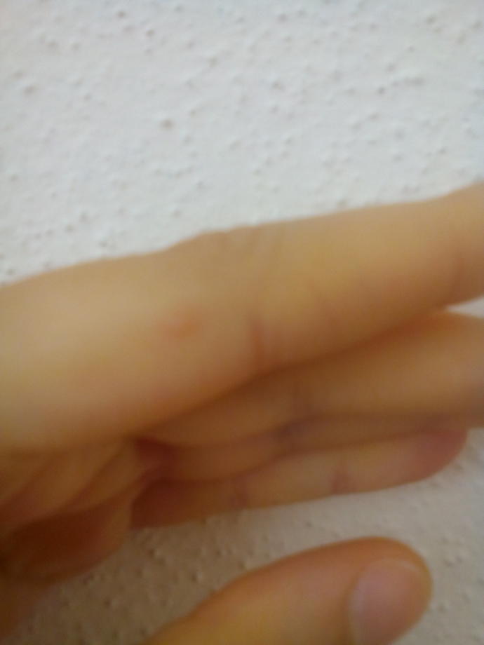 Ya bir bakar mısınız bu siğil mi acaba?