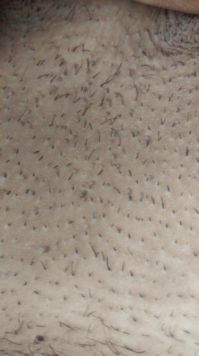 AIDS Belirtileri AIDS Belirtileri