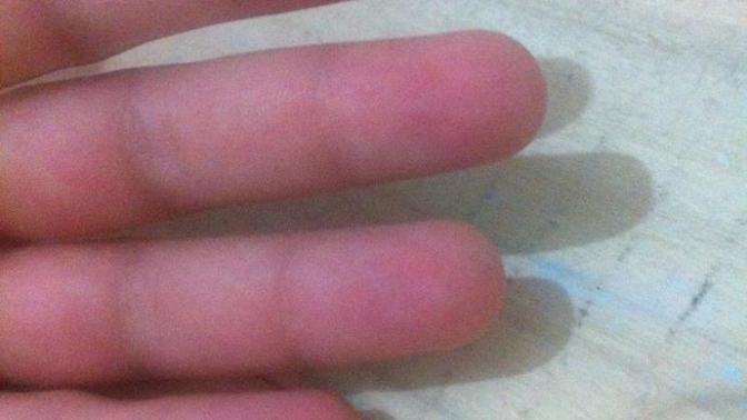 Terasta uyuyordum böcek ısırmış parmağımı şişti sizce bu böceği napmalıyım?