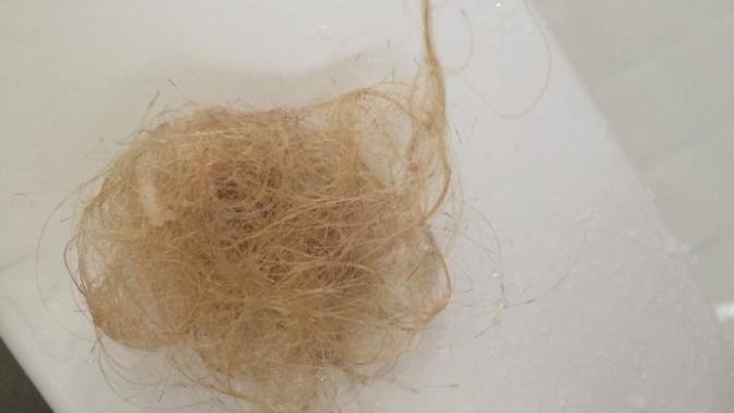 Bu kadar saçımın dökülmesi normal mi? (Resimli) ?