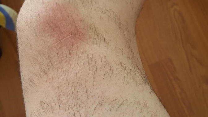( resimli ) Lazer yaptırıyorum, 3. ay oldu, bacağımdaki kıllar seyrek seyrek çıkıyor, neden?