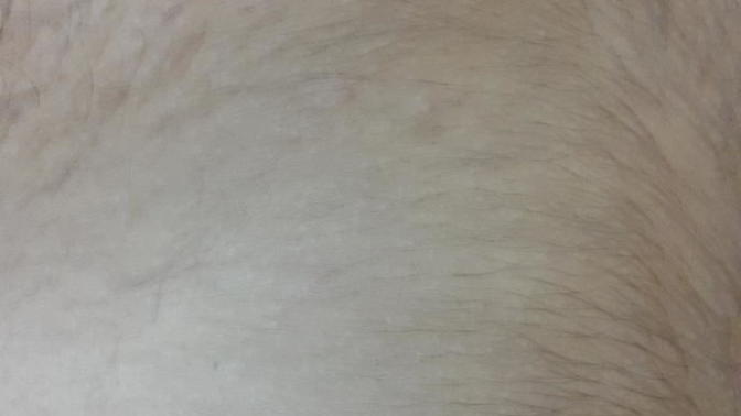 Hirsutismus (aşırı kıllanma) hastalığı var bende tüm hayatım mahvoldu :(?
