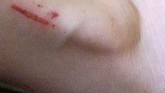 (Fotolu) kesik yarasi nasil iyilestirili?