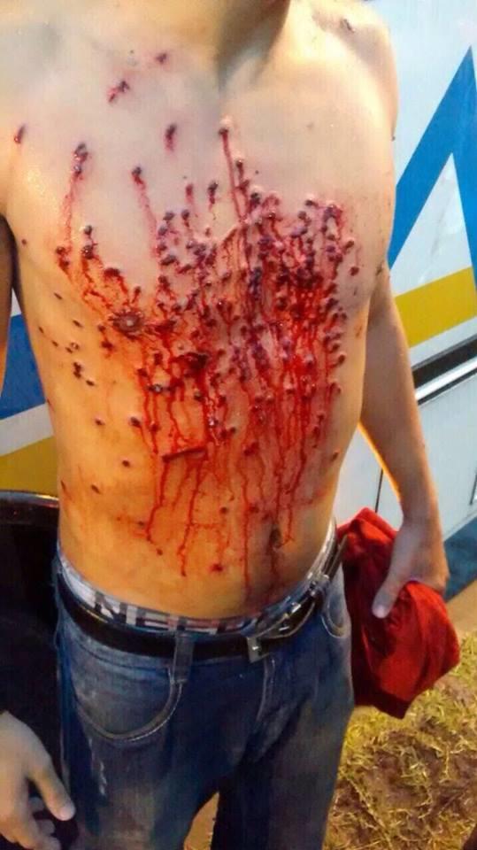 Sizce Fotoğraftaki Adam Nasıl Yaralanmış  ?