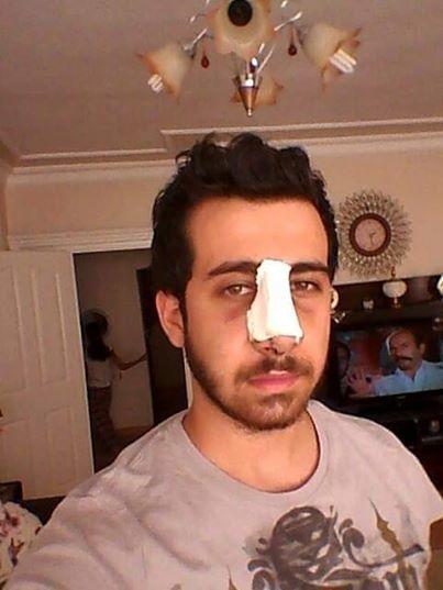 3 gün önce burun estetigi oldum akliniza takilan herseyi sorabilirsiniz ?