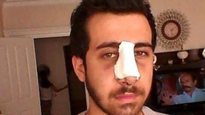 3 gün önce burun estetigi oldum akliniza takilan herseyi sorabilirsiniz?