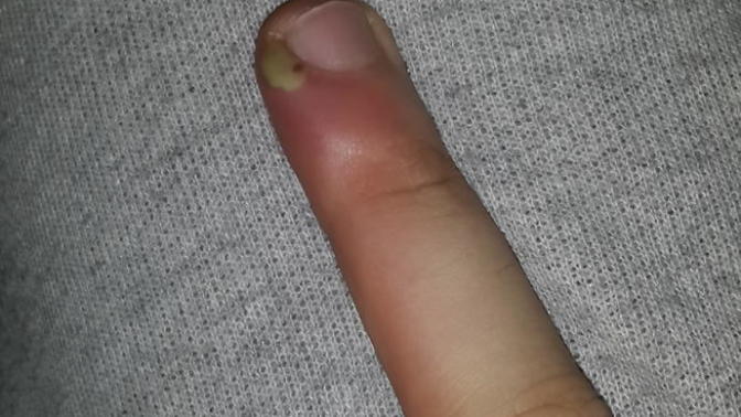Parmağımın kenarındaki şişlik nedir ne yapayım takrik verin?