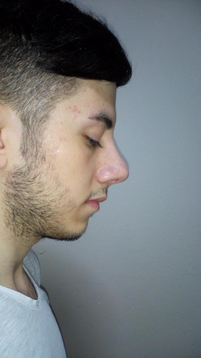 Gençler Benim ten rengim ne oluyor?
