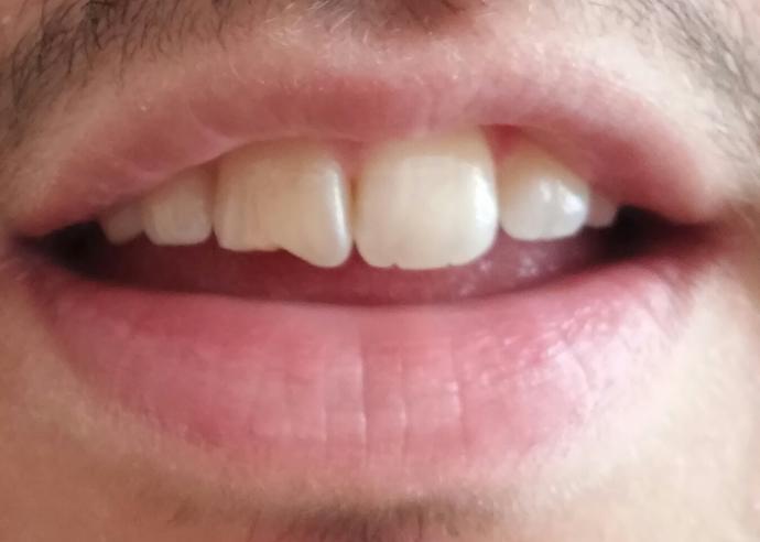 (Resimli soru) Ön dişim kırıldı acil yardımınız lazım çok korkuyorum?