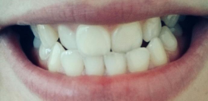 Diş teli taktırıyorum (Fotoğraflı) çok mu kötü?