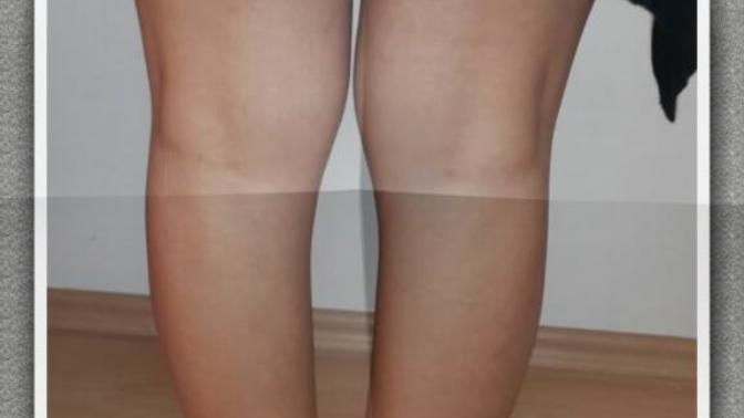 Özellikle erkekler size soruyorum sizce benimki gibi bir çarpık bacak itici mi?