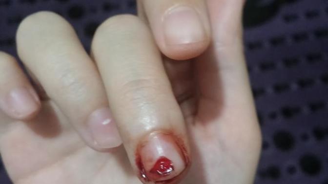 Arkadaşlar tırnağımın bir kısmı koptu sizce doktora gitmeli miyim? (kan tutanlar bakmasın) ?