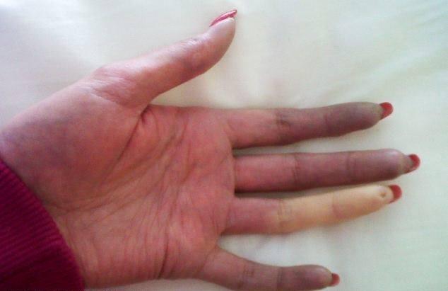 Raynaud Fenomeni Vakasını Biliyor muydunuz?