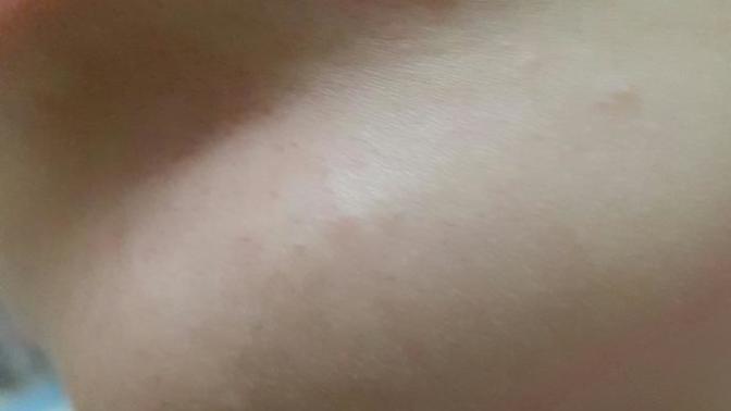 Uçuk çıktı hangi kremi surmeliyim?