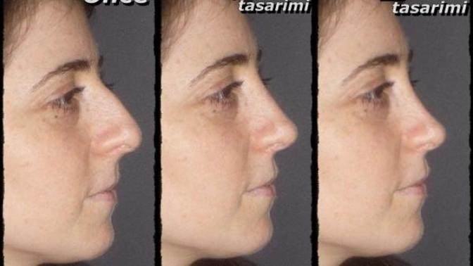 Burnum sunun gibi ve burun egzersizleri filan varmis duzeltilir mi bu?