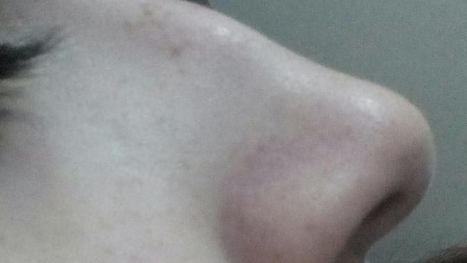 Burnum şekilsiz, ama estetikten korkuyorum daha kötü olur diye?( resimli,+1li)?