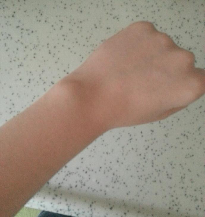Bileğimdeki çıkıntı ne?