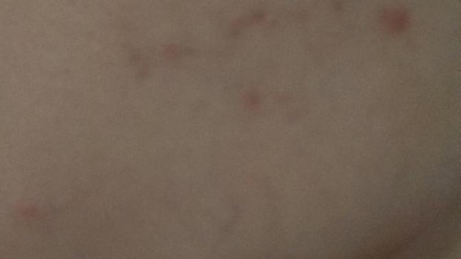 Geçmeyen bu sivilce izlerinden nasıl kurtulurum? Ne önerirsiniz?