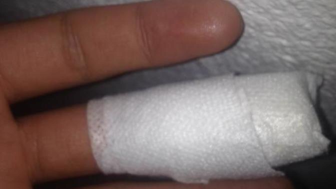 Sol ortanca parmağımı bıçak kesti kemiğe gelmemiş dün sabah 10 da dikiş attırdım ama hala zongluyo?