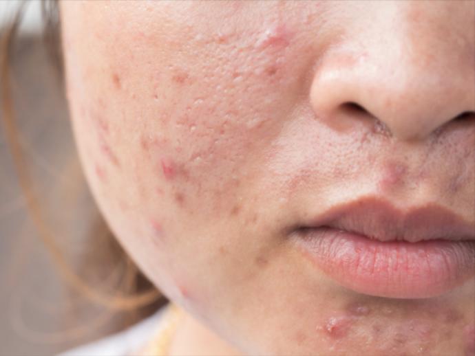 Terramycin Sivilcelere İyi Gelir mi? Sivilce için Kullanılır mı?
