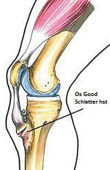 Osgood-Schlatter Hastalığı ameliyatı hakkında bilginiz var mı:( ?
