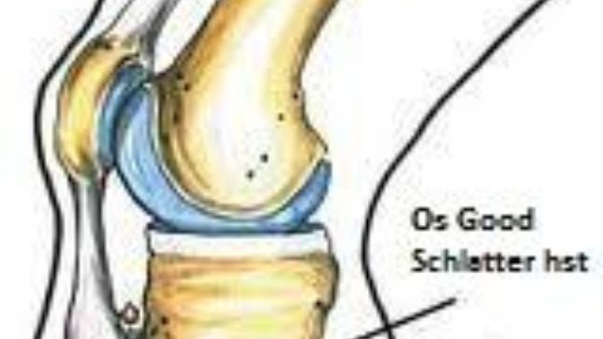 Osgood-Schlatter Hastalığı ameliyatı hakkında bilginiz var mı:( ?