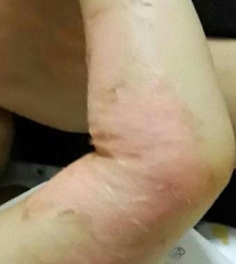 1 YAŞINDA YEĞENİMİ KOLU YANDI BAKAR MISINIZ ?