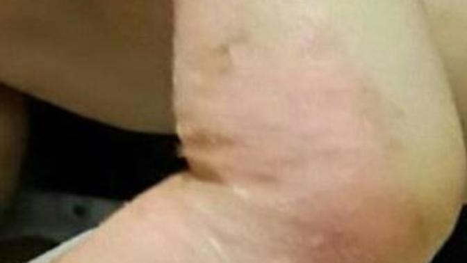 1 YAŞINDA YEĞENİMİ KOLU YANDI BAKAR MISINIZ?
