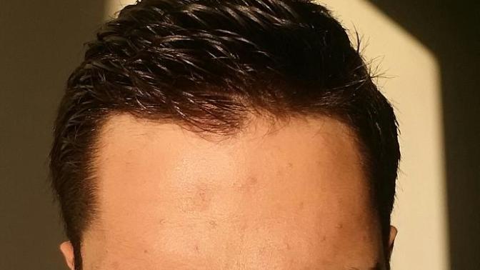 Kızlar, Alnım çokmu geniş :((?