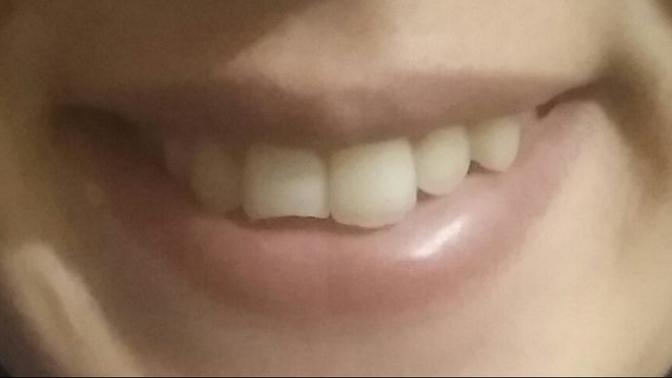 Ön disim kırıldı yaptırmali miyim sizce böyle cok mu kötü?