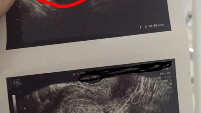 Kızlar, Kız arkadaşım az önce ultrason resmi attı yalan mı söylüyor anlamadım acil yardımmm?