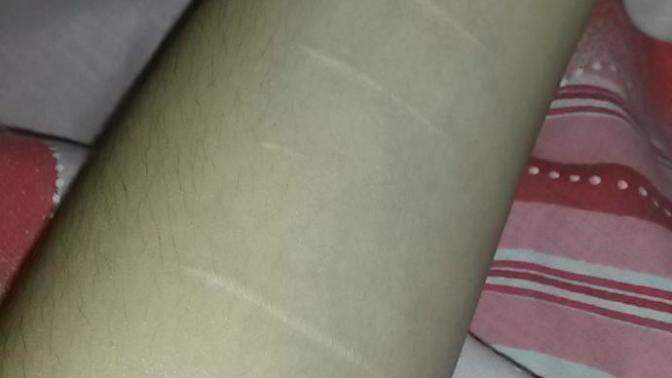 Jilet izleri acilll resimli?