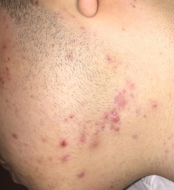 Sivilce (resimli)?