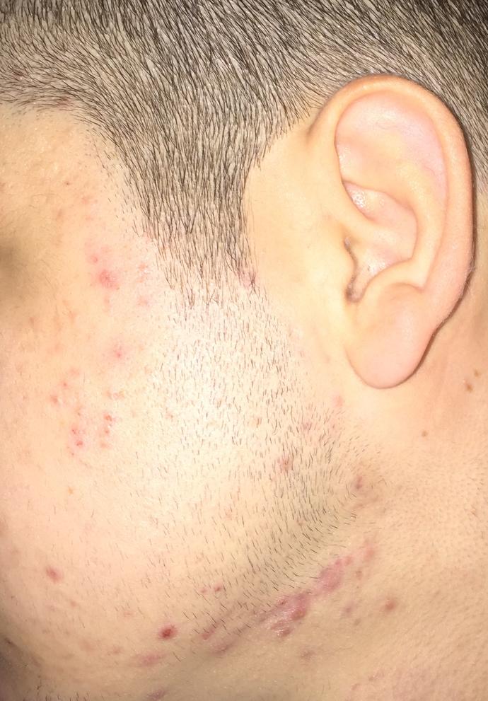 Sivilce (resimli)?