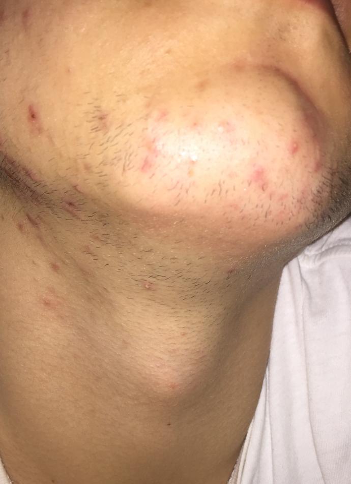 Sivilce (resimli)?