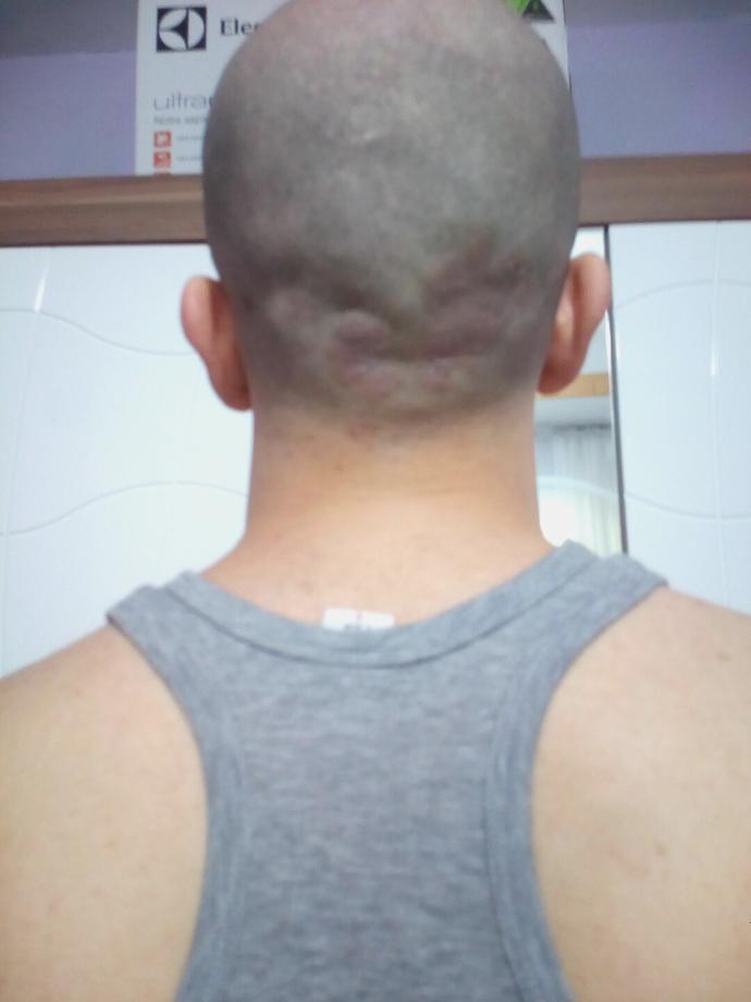 Saçımı kestim ustura ile Ensemdeki yara  da nedir böyle ?