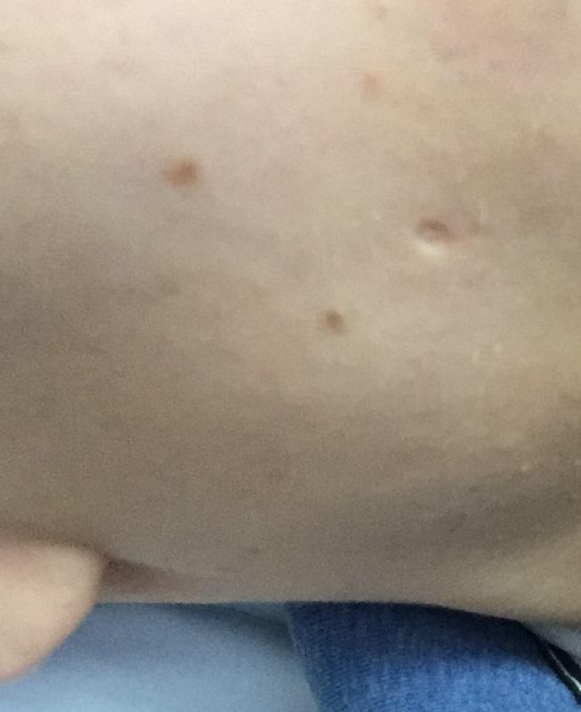 yüzümdeki bu izler yüzeysel ve 2 tane ben var yüzeysel nasıl alınır bunlar bakın  bir  ya ?