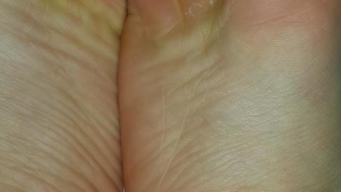 Yardım edin?  bir  ilaç kullandım nasirlar icin ve hep soyuldu. Nasıl düzelir?