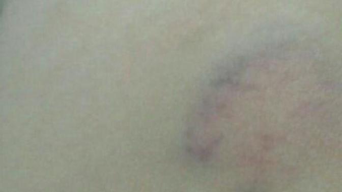 Boynumdaki bu morluk nasıl geçer?