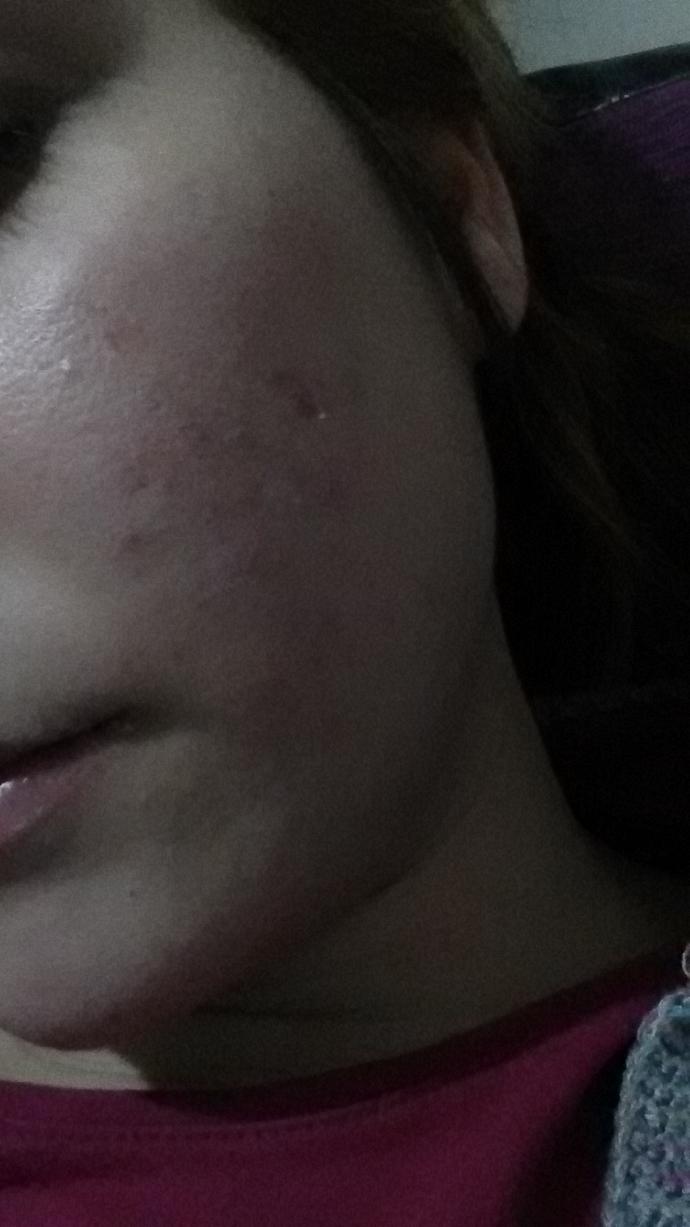 Roaccutane kullanimi 2. Aydayim alerji gibi oldu normal mi ? Resimli ?